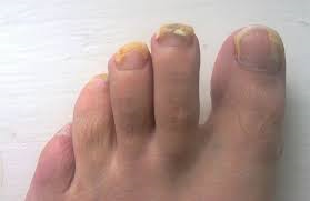 hongos
