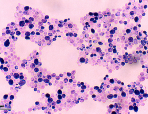 candidiasis