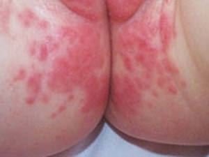 dermatitis del pañal